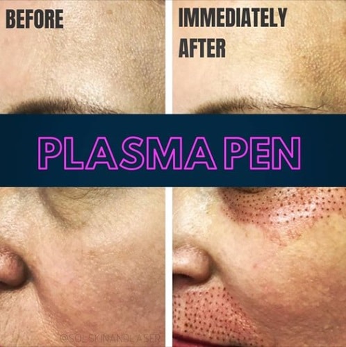 Plasma Pen Before And After