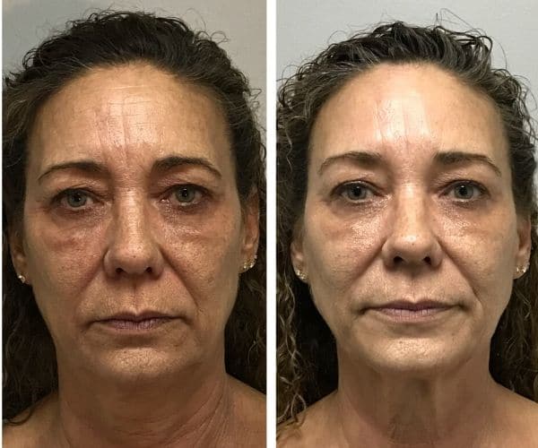 Natural Growth Factor Injection PRP Facelift Before and After of Actual Patients | Source Of Health In Scottsdale, AZ