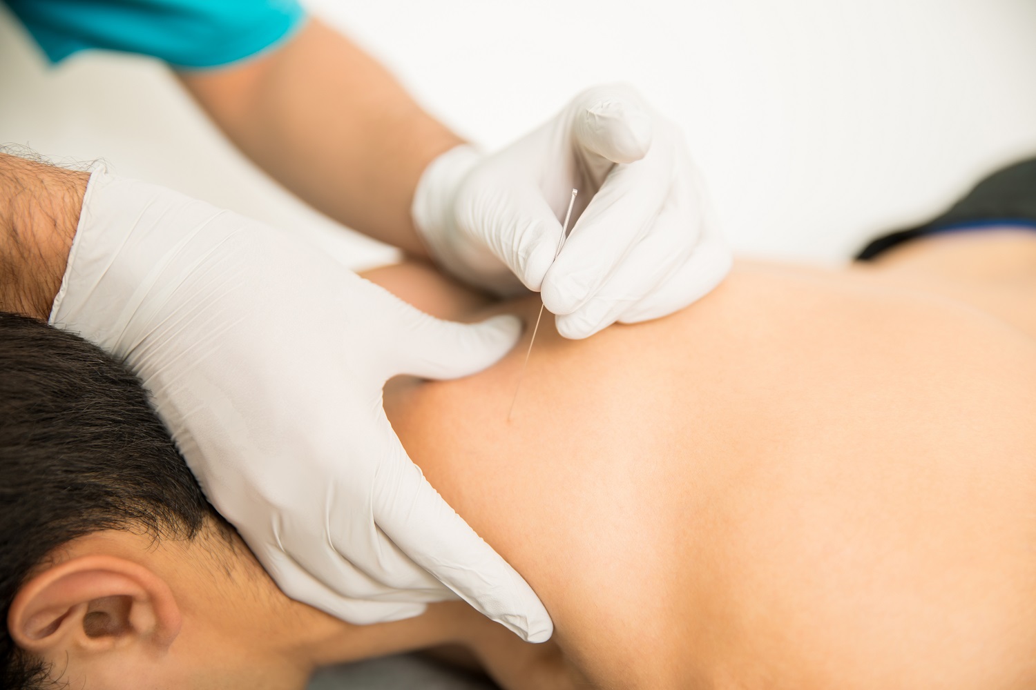 Get Dry Needling in Scottsdale, AZ | Source of Health